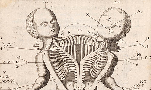 Medieval illustration of conjoined twins